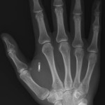 El microchip RFID implantado en seres humanos